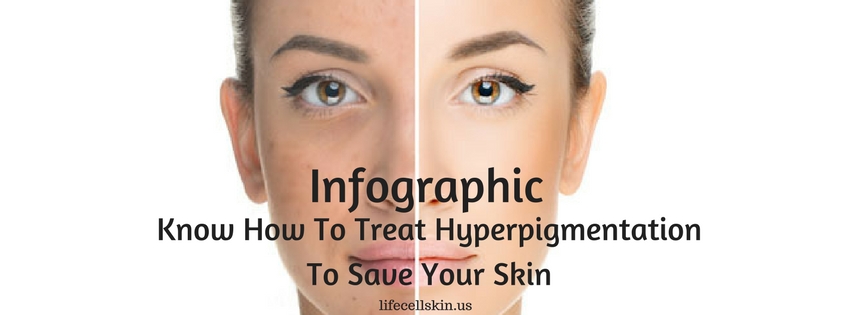 how to treat hyperpigmentation