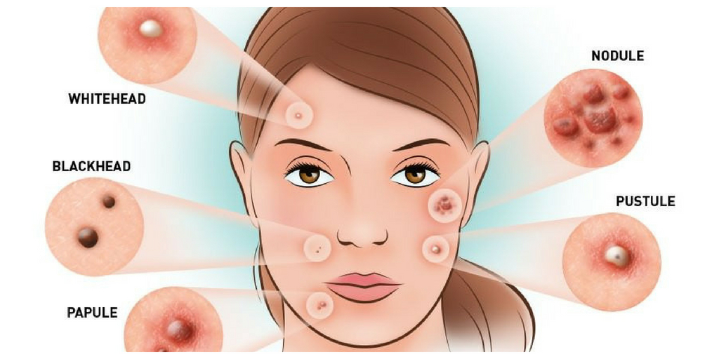 Remove Pimples